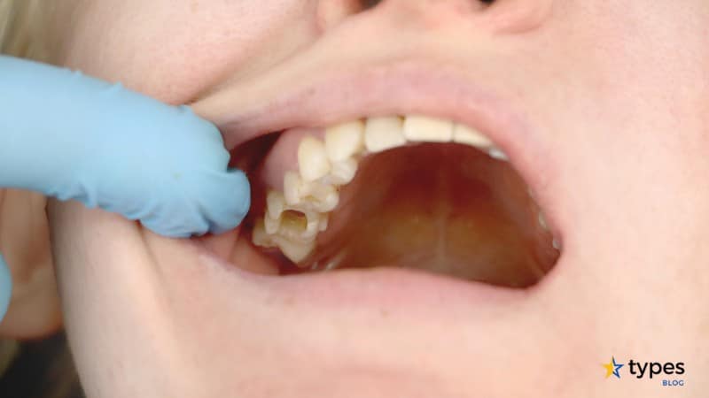 types-of-cavities